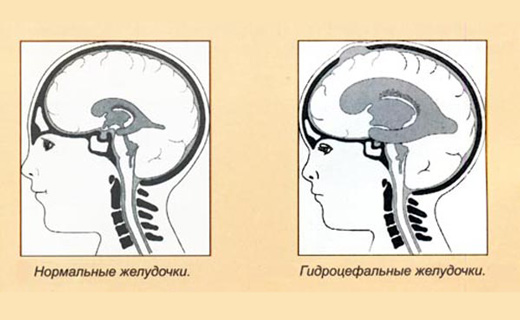 лечение гидроцефалии народными средствами