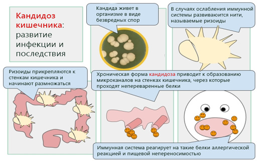 Из кандидоза может быть запоры