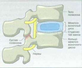 Межпозвоночные диски стерлись лечение народными средствами