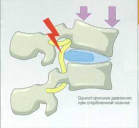 Межпозвоночные диски стерлись лечение народными средствами