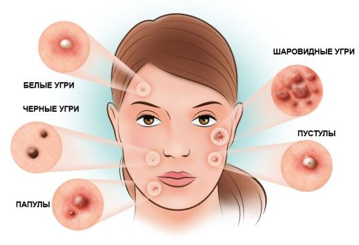 Гормональные прыщи у женщин
