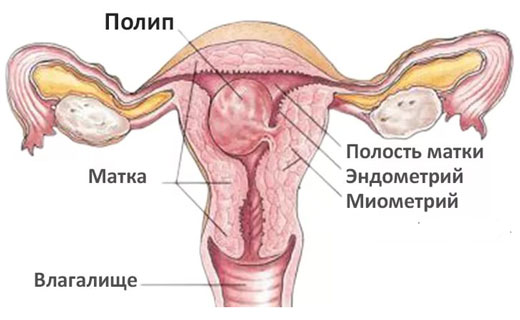 полип эндометрия