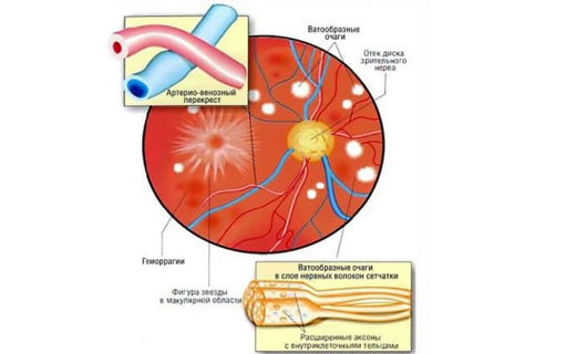 ангиопатия в картинках