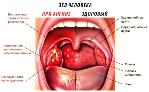 герпетическая ангина