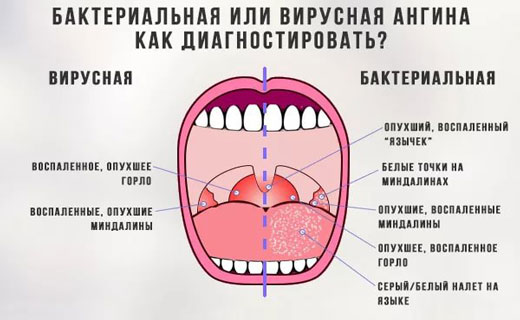 герпетическая ангина