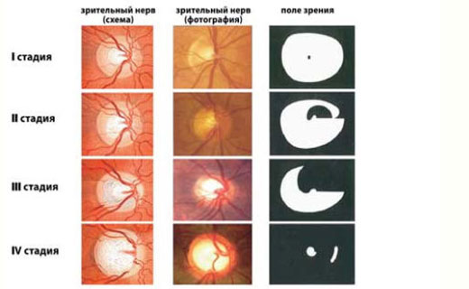 стадии атрофии при поражении зрительных нервов