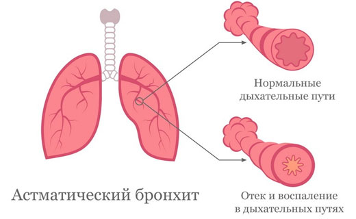 Как выглядит бронхит у ребенка