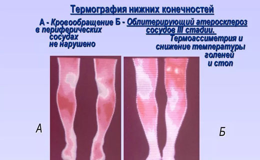 Атеросклероз нижних конечностей симптомы фото Инвалидность при атеросклерозе нижних конечностей