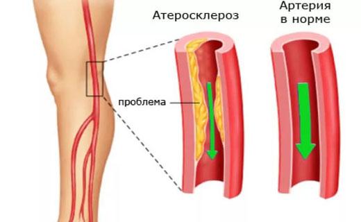 атеросклероз