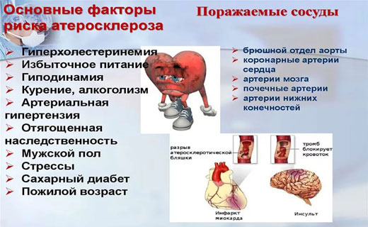 атеросклероз