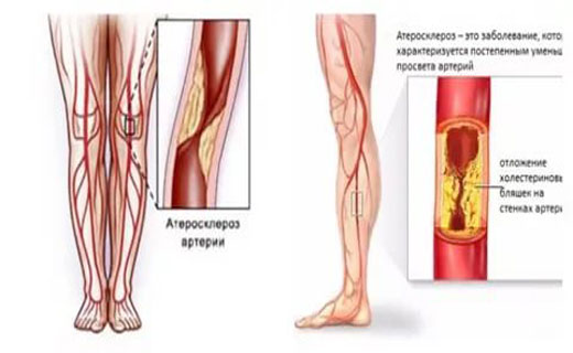 атеросклероз