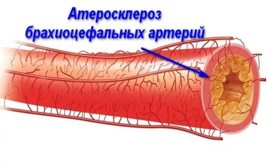 атеросклероз