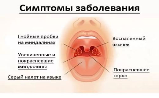 бактериальная ангина