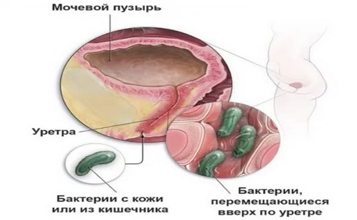 мочевой пузырь