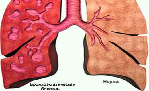 Бронхоэктатическая болезньпенсия