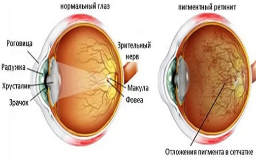 дегенерация