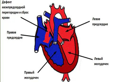 болезнь сердца