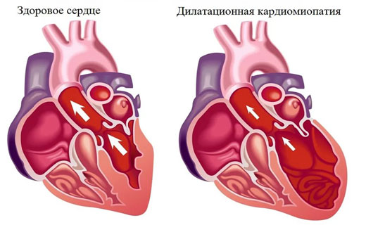 кардиомиопатия