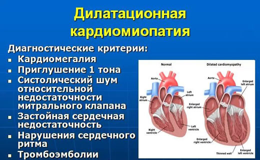 кардиомиопатия