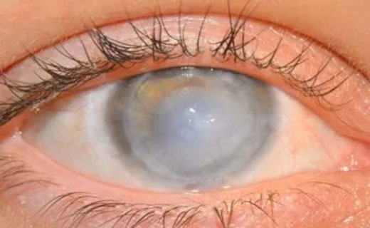 фото дистрофии глаза