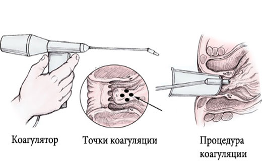 Электрокоагуляция бородавко