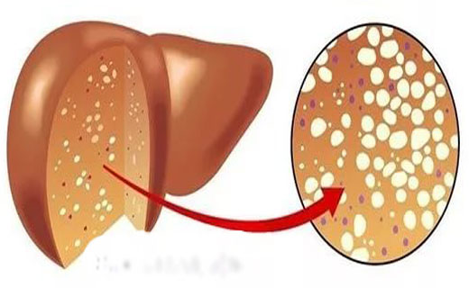 Жировой гепатоз печени