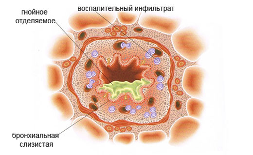 бронхит