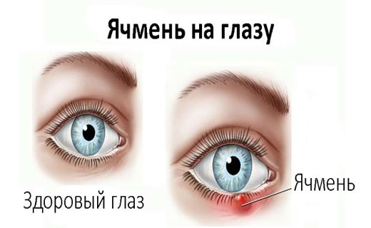 Что находится внутри ячменя на глазу Ячмень на глазу - лечение и симптомы Как лечить ячмень на глазу