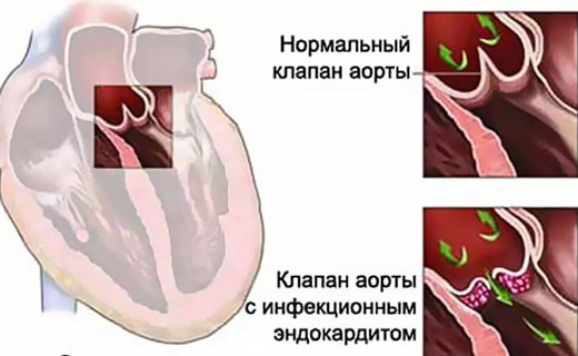 болезнь сердца