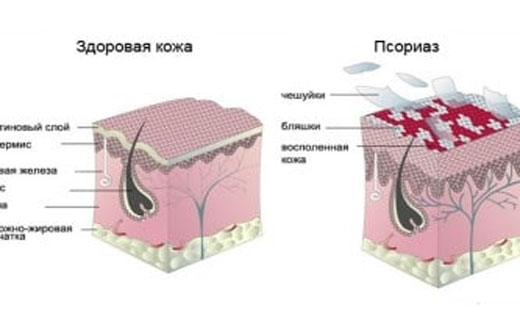 каплевидный псориаз 