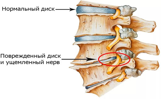 остеохондроз