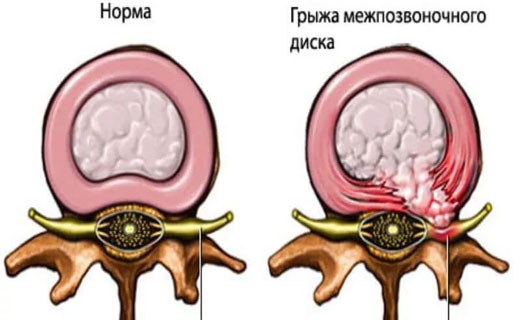 остеохондроз