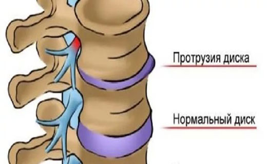 остеохондроз