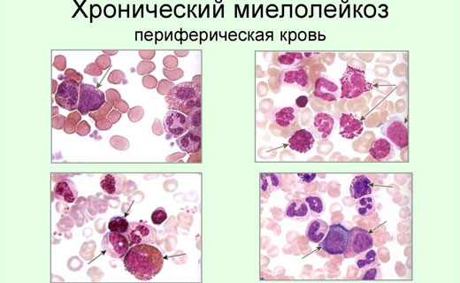 хронический миелолейкоз