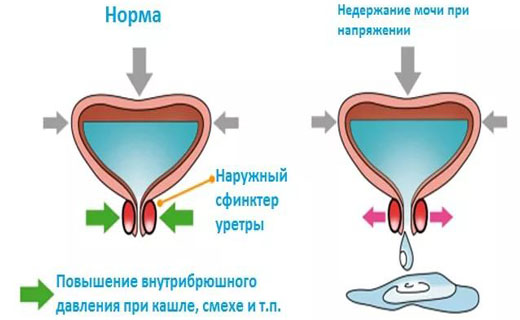 мочевой пузырь