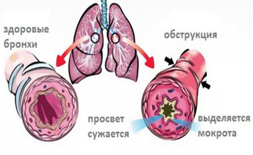 Лечение обструктивного бронхита отхаркивающие средства thumbnail