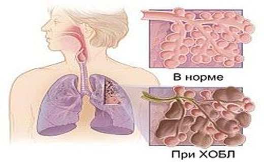 инфекции дыхательных путей