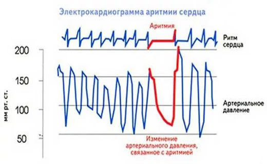 аритмия сердца