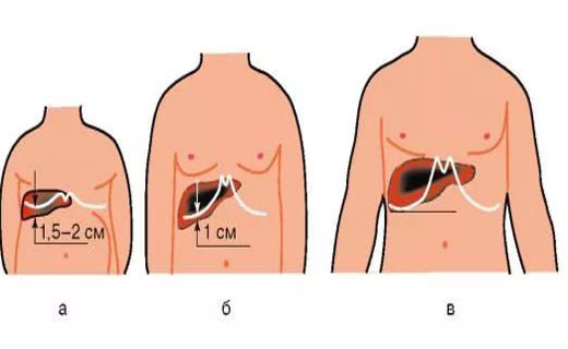 Увеличена печень в год. Печень по краю реберной дуги у детей. Расположение печени у детей. Печень нормальная и увеличенная. Гепатомегалия границы печени.
