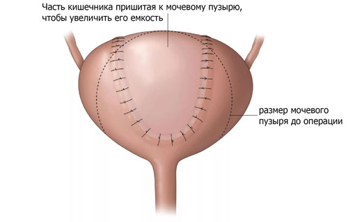 мочевой пузырь