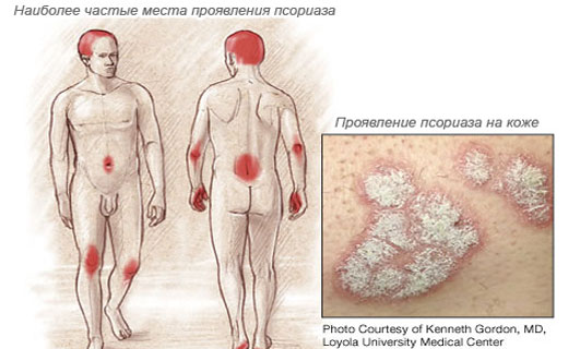 Половой псориаз лечение