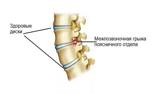 болезни позвоночника