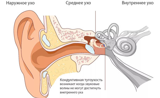 причины потери слуха