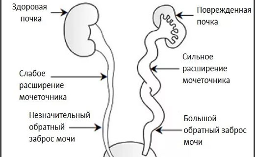 мочевой пузырь