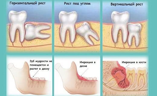 прорезание зуба мудрости