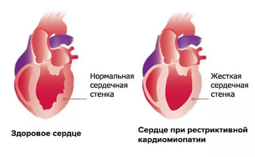 кардиомиопатия