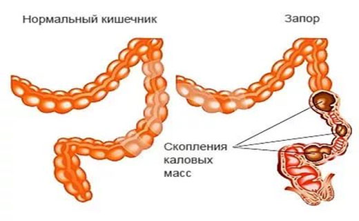 причины спастического запора