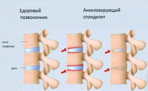 болезни позвоночника