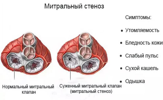 атеросклероз