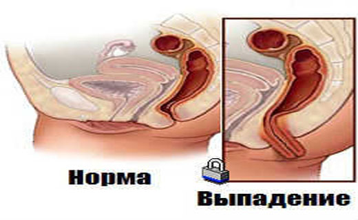 выпадение